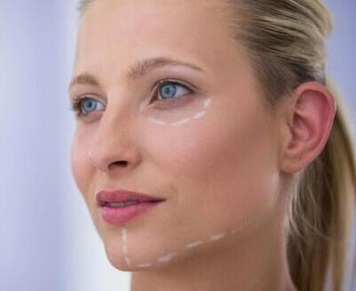 Mujer de piel clara y ojos azules mirando hacia la izquierda; se marcan líneas de puntos blancos debajo de los ojos y a lo largo de la mandíbula, indicando las zonas de intervención cosmética.