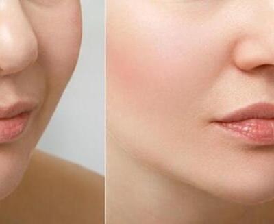 Primer plano comparativo de la parte inferior de la cara y las mejillas de una persona, que muestra las diferencias de textura y tono de la piel entre los lados izquierdo y derecho.