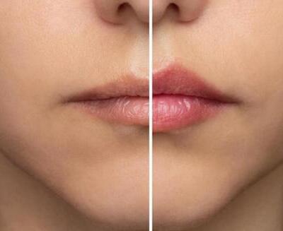 Primer plano de los labios de una persona, divididos por la mitad para mostrar una comparación; la parte izquierda muestra los labios naturales, mientras que la derecha muestra unos labios más carnosos y definidos.