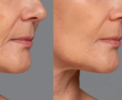 Comparación de la parte inferior de la cara de una mujer antes y después del tratamiento, que muestra una reducción de las arrugas y una piel más lisa a la derecha.