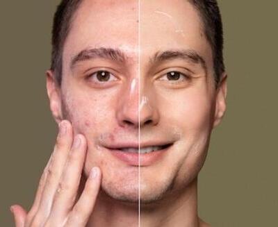 La cara de un hombre se muestra partida verticalmente; el lado izquierdo tiene acné y manchas, mientras que el derecho aparece claro y liso.