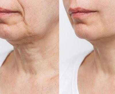 Comparación de la parte inferior de la cara y el cuello, mostrando arrugas y flacidez a la izquierda y una piel más lisa y firme a la derecha.