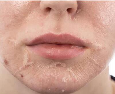 Primer plano de la parte inferior de la cara de una persona que muestra piel seca y descamada alrededor de la boca, la barbilla y las mejillas.